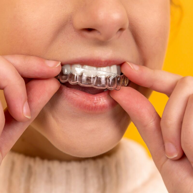 Invisalign pris